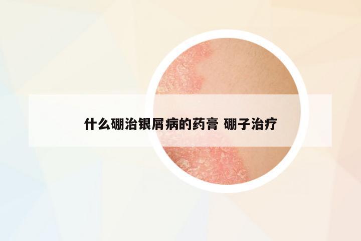 什么硼治銀屑病的藥膏 硼子治療