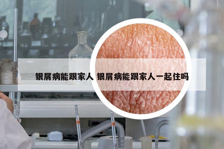 銀屑病能跟家人 銀屑病能跟家人一起住嗎