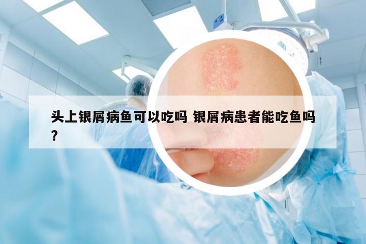 頭上銀屑病魚可以吃嗎 銀屑病患者能吃魚嗎?