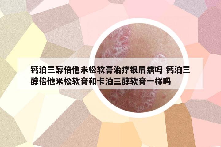 鈣泊三醇倍他米松軟膏治療銀屑病嗎 鈣泊三醇倍他米松軟膏和卡泊三醇軟膏一樣嗎