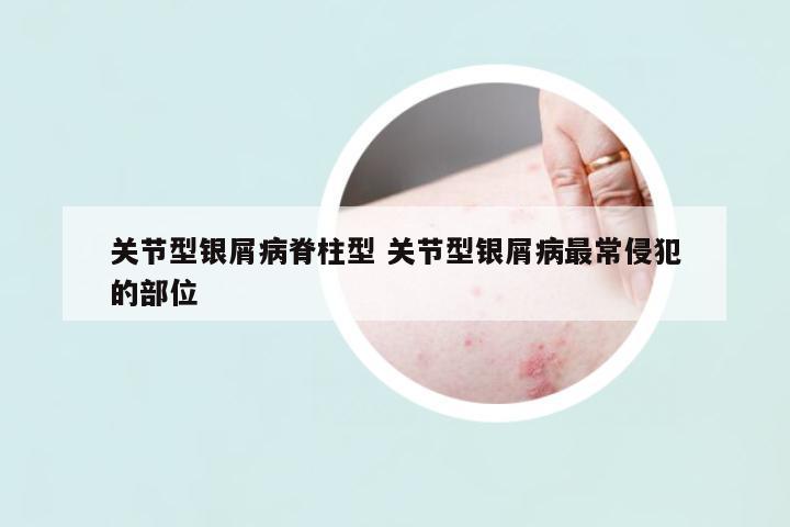 關(guān)節(jié)型銀屑病脊柱型 關(guān)節(jié)型銀屑病最常侵犯的部位