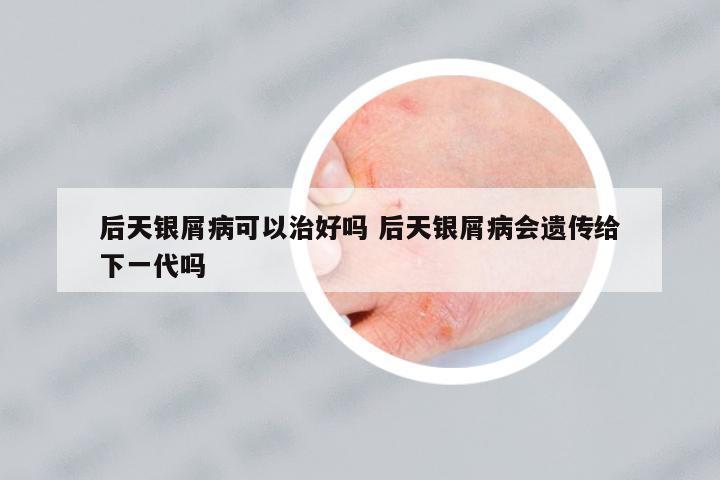 后天銀屑病可以治好嗎 后天銀屑病會遺傳給下一代嗎