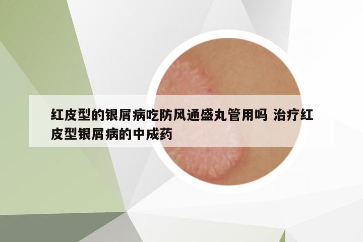 紅皮型的銀屑病吃防風(fēng)通盛丸管用嗎 治療紅皮型銀屑病的中成藥