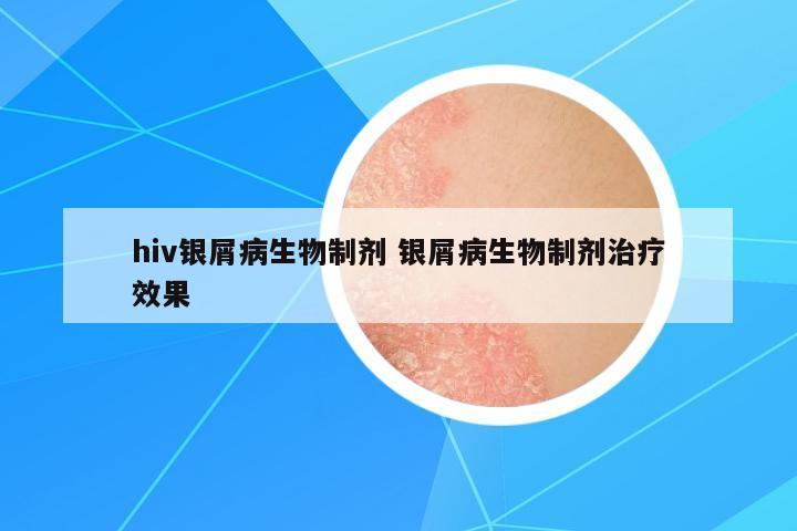 hiv銀屑病生物制劑 銀屑病生物制劑治療效果