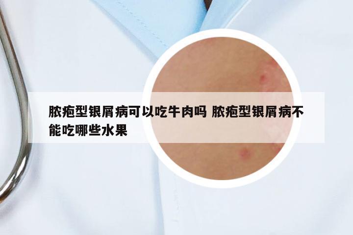 膿皰型銀屑病可以吃牛肉嗎 膿皰型銀屑病不能吃哪些水果