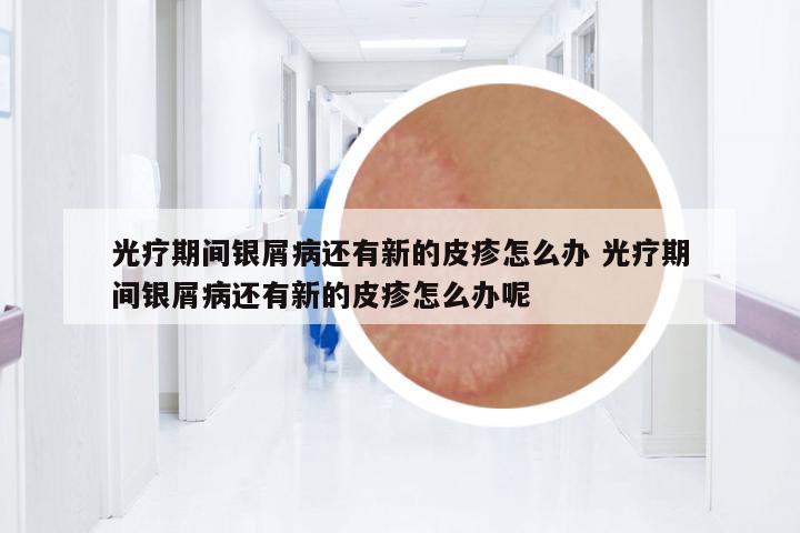光療期間銀屑病還有新的皮疹怎么辦 光療期間銀屑病還有新的皮疹怎么辦呢