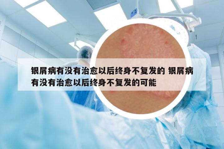 銀屑病有沒有治愈以后終身不復(fù)發(fā)的 銀屑病有沒有治愈以后終身不復(fù)發(fā)的可能