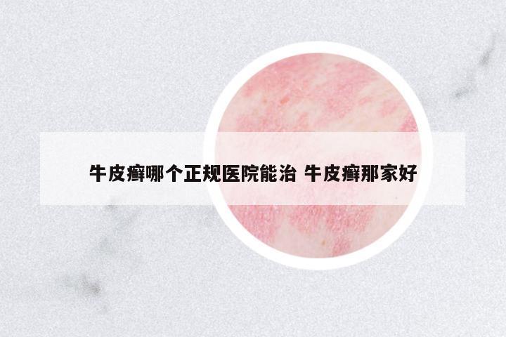牛皮癬哪個正規(guī)醫(yī)院能治 牛皮癬那家好