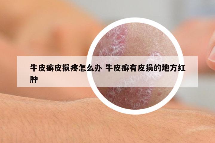 牛皮癬皮損疼怎么辦 牛皮癬有皮損的地方紅腫
