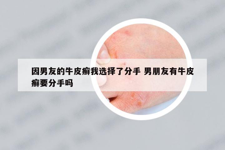 因男友的牛皮癬我選擇了分手 男朋友有牛皮癬要分手嗎