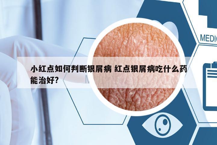 小紅點(diǎn)如何判斷銀屑病 紅點(diǎn)銀屑病吃什么藥能治好?
