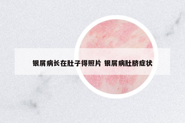 銀屑病長(zhǎng)在肚子得照片 銀屑病肚臍癥狀