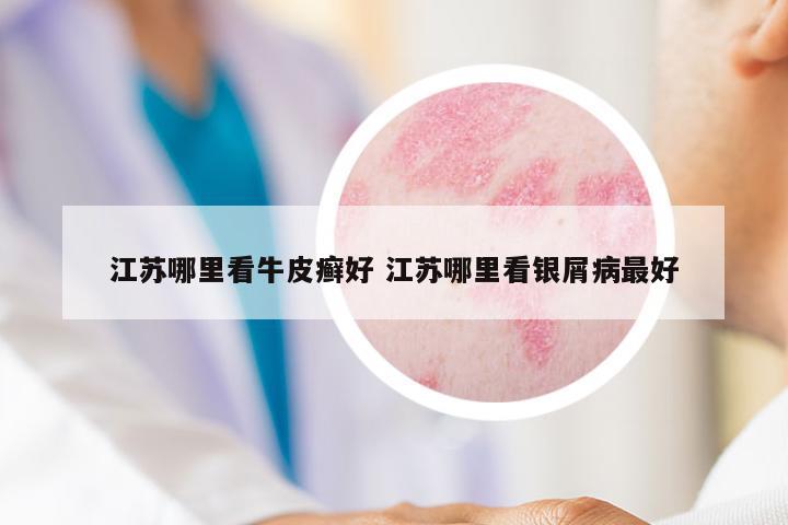 江蘇哪里看牛皮癬好 江蘇哪里看銀屑病最好