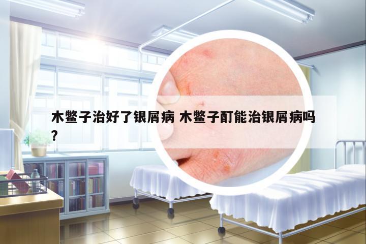 木鱉子治好了銀屑病 木鱉子酊能治銀屑病嗎?
