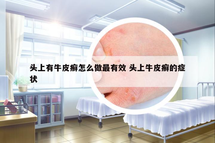 頭上有牛皮癬怎么做最有效 頭上牛皮癬的癥狀