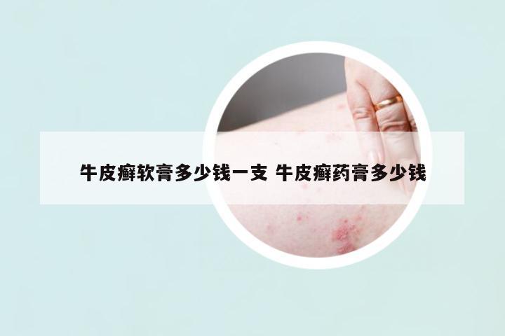 牛皮癬軟膏多少錢一支 牛皮癬藥膏多少錢