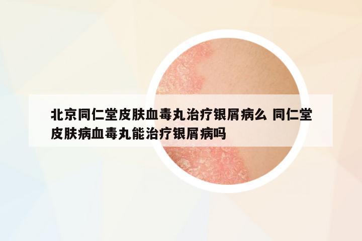 北京同仁堂皮膚血毒丸治療銀屑病么 同仁堂皮膚病血毒丸能治療銀屑病嗎