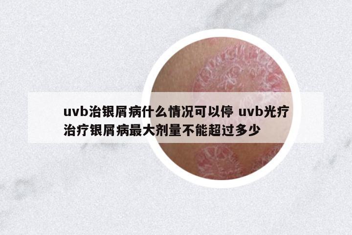 uvb治銀屑病什么情況可以停 uvb光療治療銀屑病最大劑量不能超過多少