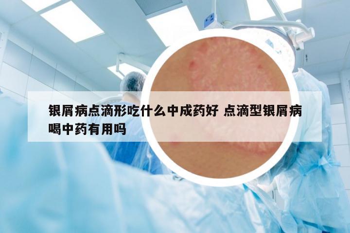 銀屑病點滴形吃什么中成藥好 點滴型銀屑病喝中藥有用嗎