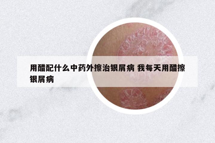 用醋配什么中藥外擦治銀屑病 我每天用醋擦銀屑病