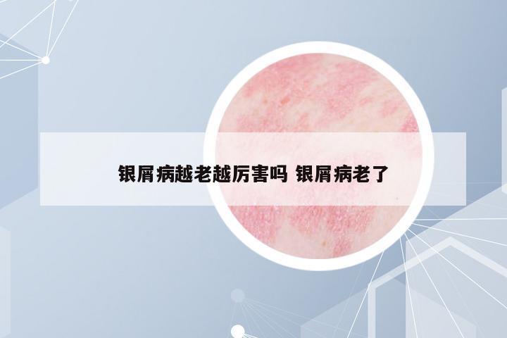 銀屑病越老越厲害嗎 銀屑病老了