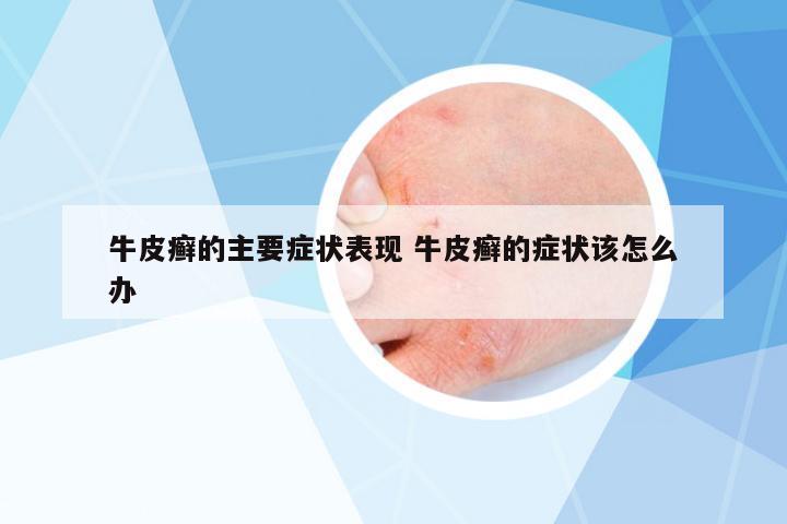 牛皮癬的主要癥狀表現(xiàn) 牛皮癬的癥狀該怎么辦