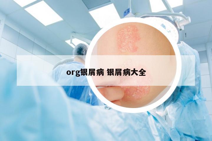 org銀屑病 銀屑病大全