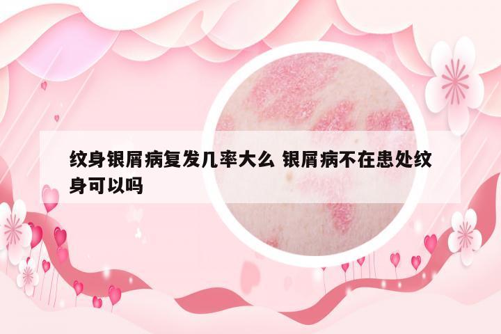 紋身銀屑病復發(fā)幾率大么 銀屑病不在患處紋身可以嗎