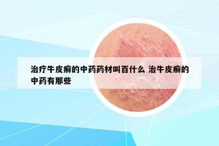治療牛皮癬的中藥藥材叫百什么 治牛皮癬的中藥有那些