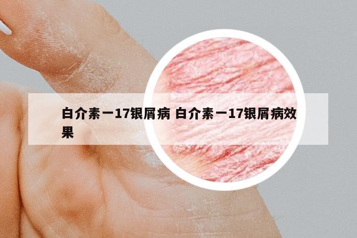 白介素一17銀屑病 白介素一17銀屑病效果