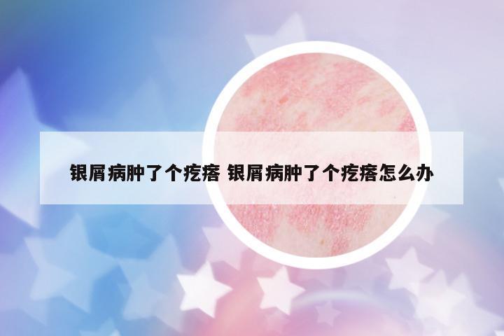 銀屑病腫了個(gè)疙瘩 銀屑病腫了個(gè)疙瘩怎么辦