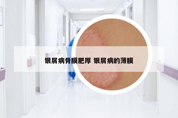 銀屑病骨膜肥厚 銀屑病的薄膜