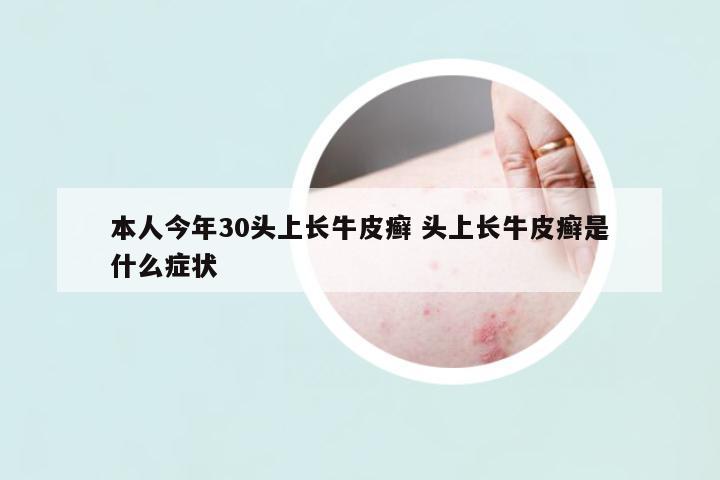 本人今年30頭上長(zhǎng)牛皮癬 頭上長(zhǎng)牛皮癬是什么癥狀