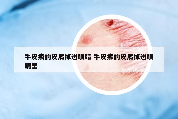牛皮癬的皮屑掉進(jìn)眼睛 牛皮癬的皮屑掉進(jìn)眼睛里