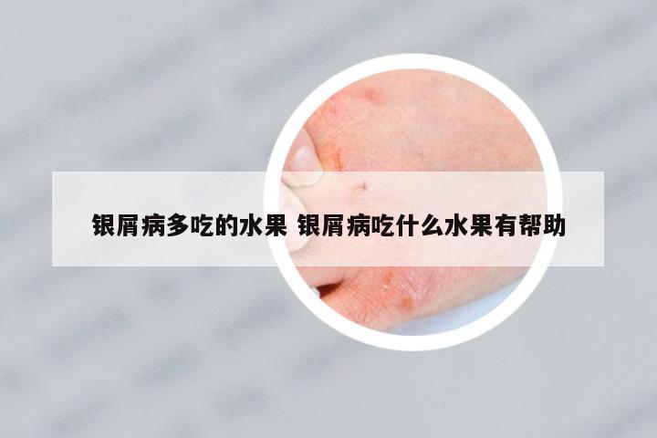 銀屑病多吃的水果 銀屑病吃什么水果有幫助