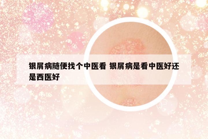 銀屑病隨便找個中醫(yī)看 銀屑病是看中醫(yī)好還是西醫(yī)好