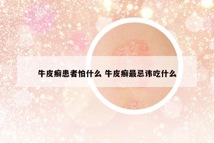 牛皮癬患者怕什么 牛皮癬最忌諱吃什么