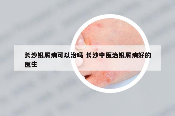 長(zhǎng)沙銀屑病可以治嗎 長(zhǎng)沙中醫(yī)治銀屑病好的醫(yī)生