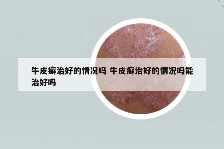 牛皮癬治好的情況嗎 牛皮癬治好的情況嗎能治好嗎