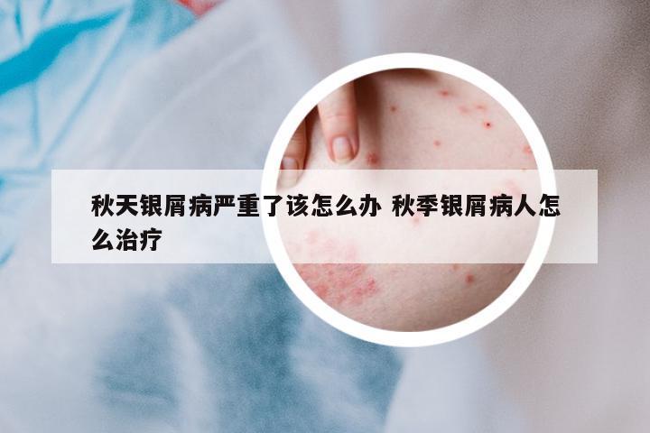秋天銀屑病嚴重了該怎么辦 秋季銀屑病人怎么治療