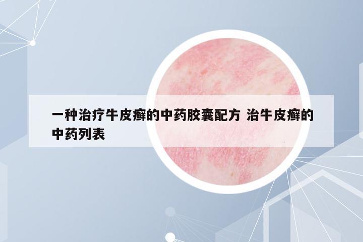 一種治療牛皮癬的中藥膠囊配方 治牛皮癬的中藥列表