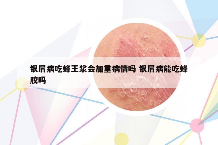 銀屑病吃蜂王漿會(huì)加重病情嗎 銀屑病能吃蜂膠嗎