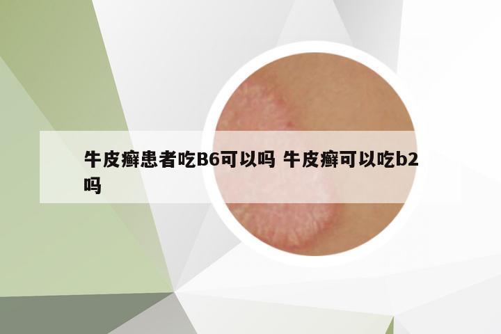 牛皮癬患者吃B6可以嗎 牛皮癬可以吃b2嗎