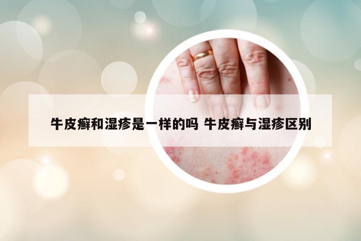 牛皮癬和濕疹是一樣的嗎 牛皮癬與濕疹區(qū)別