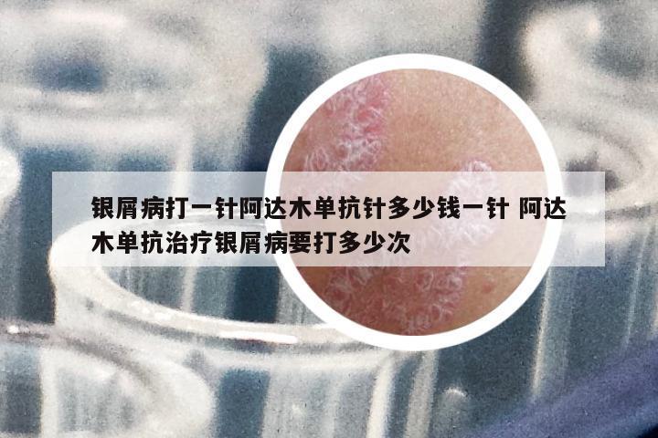 銀屑病打一針阿達(dá)木單抗針多少錢一針 阿達(dá)木單抗治療銀屑病要打多少次