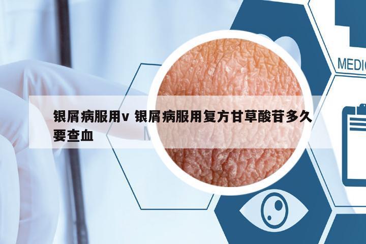 銀屑病服用v 銀屑病服用復(fù)方甘草酸苷多久要查血