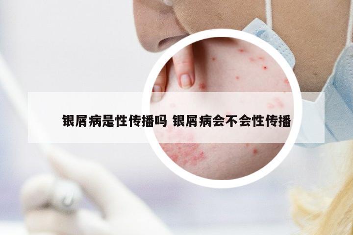 銀屑病是性傳播嗎 銀屑病會不會性傳播
