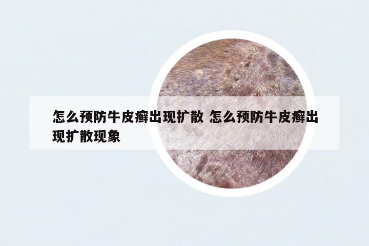 怎么預(yù)防牛皮癬出現(xiàn)擴(kuò)散 怎么預(yù)防牛皮癬出現(xiàn)擴(kuò)散現(xiàn)象