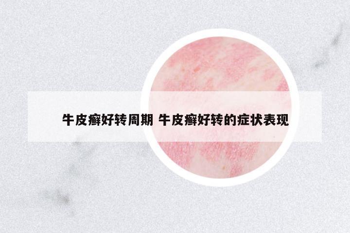 牛皮癬好轉(zhuǎn)周期 牛皮癬好轉(zhuǎn)的癥狀表現(xiàn)