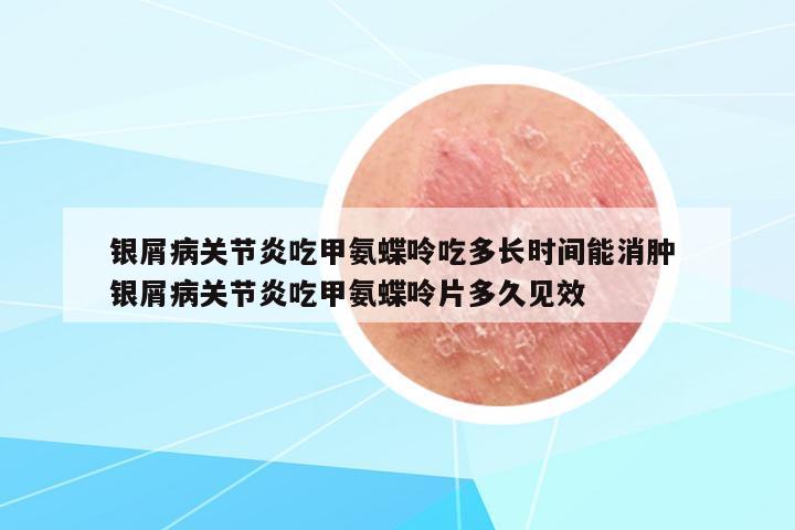 銀屑病關(guān)節(jié)炎吃甲氨蝶呤吃多長時間能消腫 銀屑病關(guān)節(jié)炎吃甲氨蝶呤片多久見效